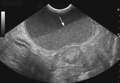 Rahimde Sıvı Birikmesi Neden Olur? Belirtileri ve Tedavisi Nelerdir? 