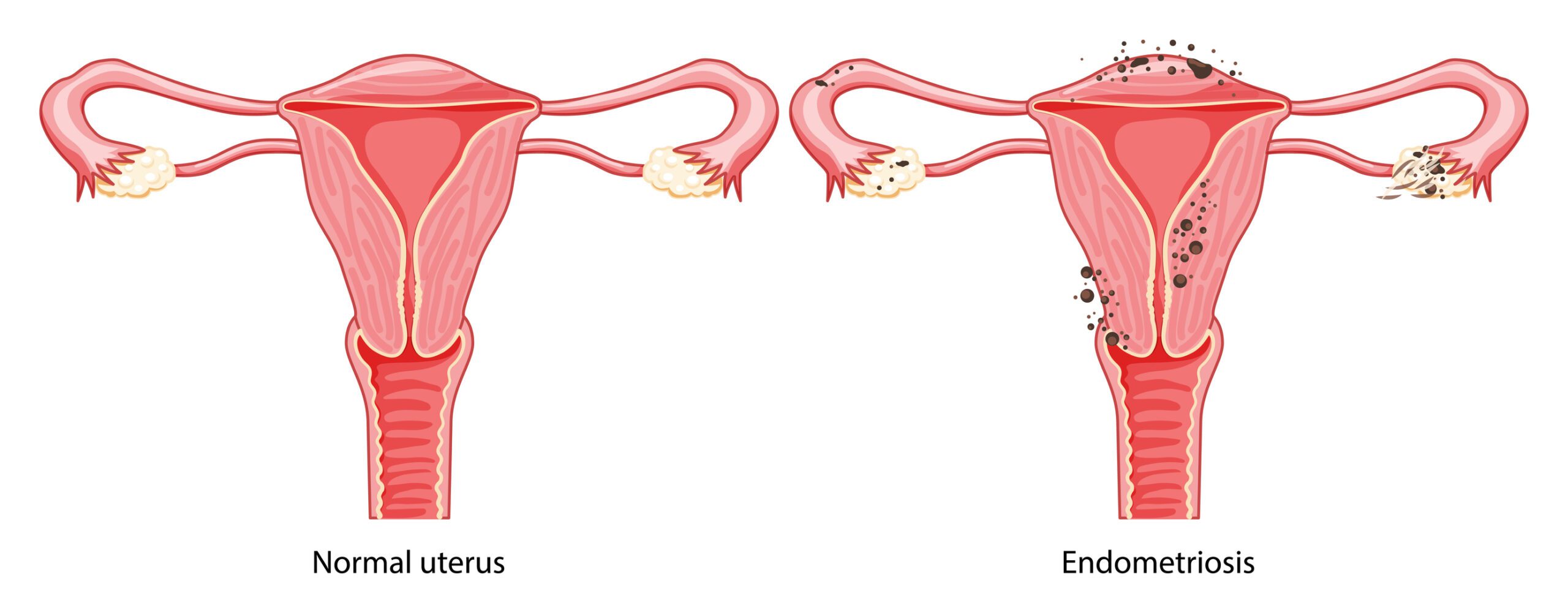 Endometriozis: Kadın Sağlığı Üzerindeki Etkileri ve Tedavi Seçenekleri Nelerdir?