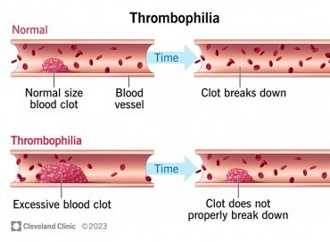 Gebelikte trombofili (pıhtılaşma bozukluğu) riskleri ve yönetimi nasıldır?