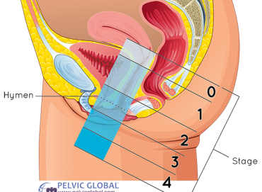 Doğum sonrası pelvik organ prolapsusu (sarkma) belirtileri ve tedavi seçenekleri nelerdir