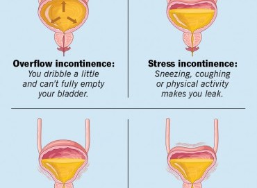 Kadınlarda İdrar Kaçırma Problemi ve Çözüm Yöntemleri