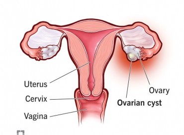 Yumurtalık Kistleri: Belirtiler, Tanı ve Tedavi Süreci