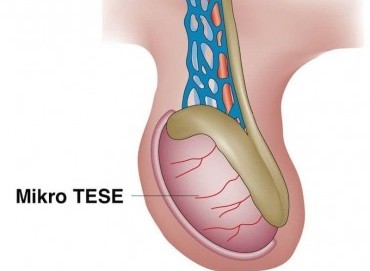 TESE / Mikro TESE Nedir? Sıfır Sperm (Azoospermi) Tedavisi