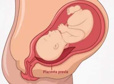 Plasenta Previa Nedir? Belirtileri ve Doğum Seçenekleri
