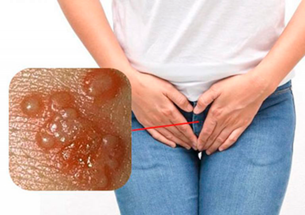 Genital Siğil Nedir?