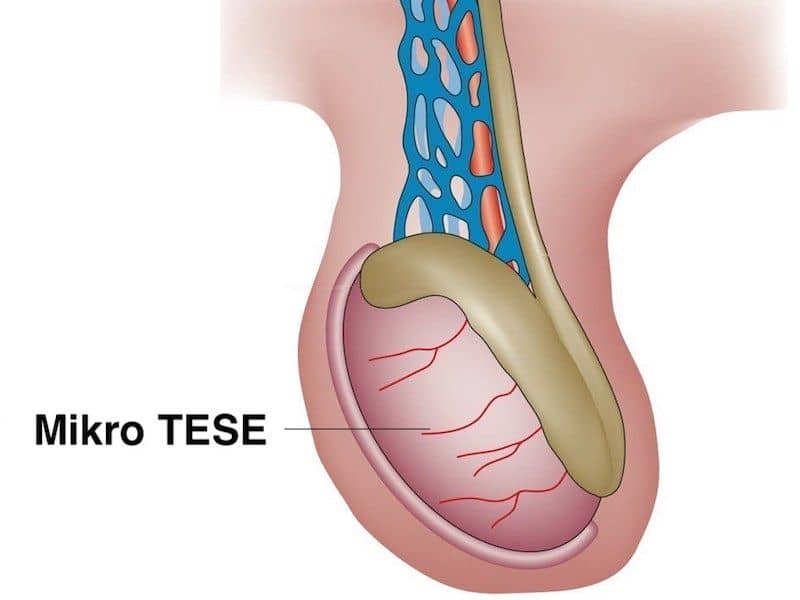 TESE / Mikro TESE Nedir? Sıfır Sperm (Azoospermi) Tedavisi