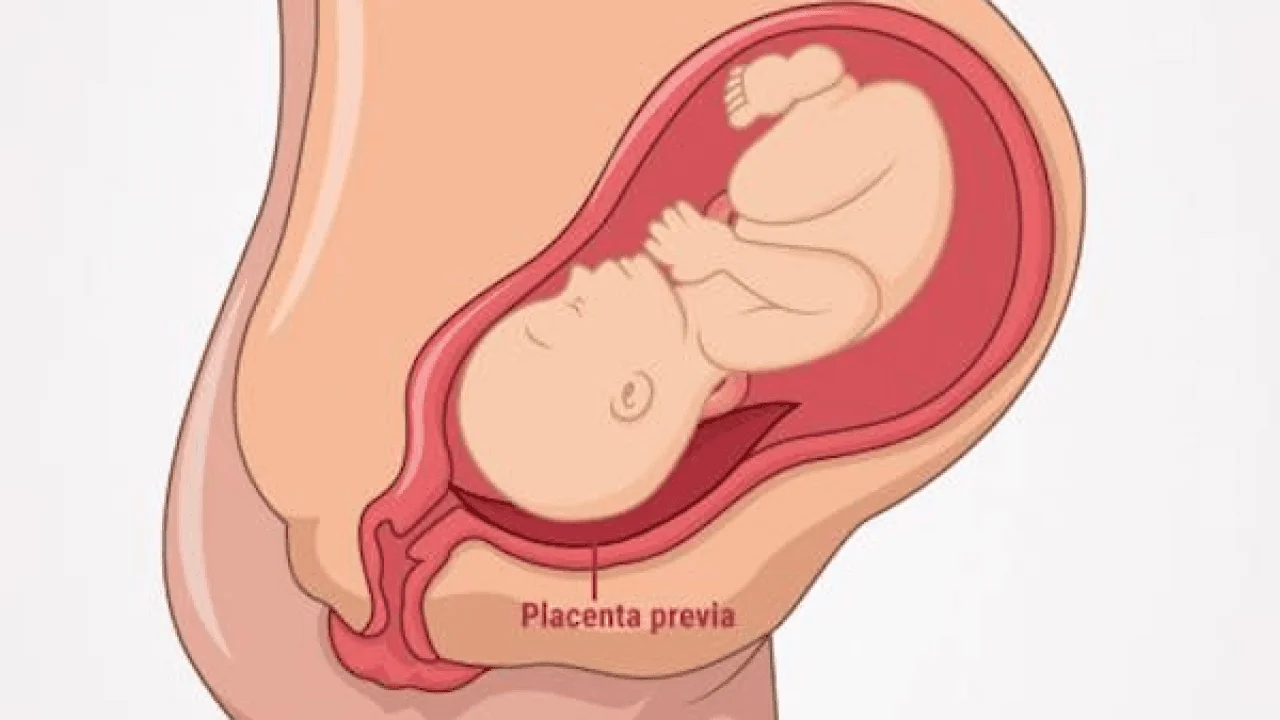 Plasenta Previa Nedir? Belirtileri ve Doğum Seçenekleri